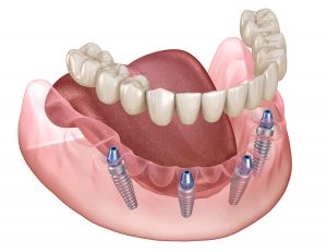 5 powodów, dla których implanty dentystyczne są skuteczniejsze niż aparat ortodontyczny
