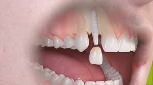 Jak wybrać najlepsze implanty dentystyczne: 6 kroków, aby zacząć