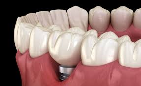 Jaka jest różnica między implantem dentystycznym a kością zęba?