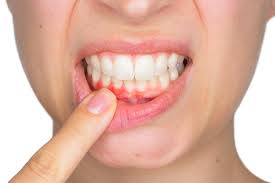 Jak leczyć ubytki w zębie: skuteczne wskazówki, domowe środki zaradcze i porady